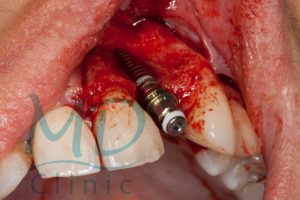 MDClinic_7_plasarea implantului
