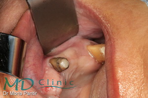 md_clinic_1_Implanturi maxilare cu RTG 21 22 24 25
