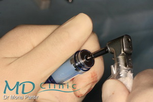 md_clinic_8_Pregatire implant