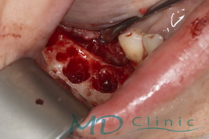 mdclinic_3_extractie_implant