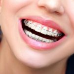 ISO-Guber-Orthodontic-Self-Ligating-Ceramic-Ortho-Bracket-Kit-Dental-Orthodontic-Braces